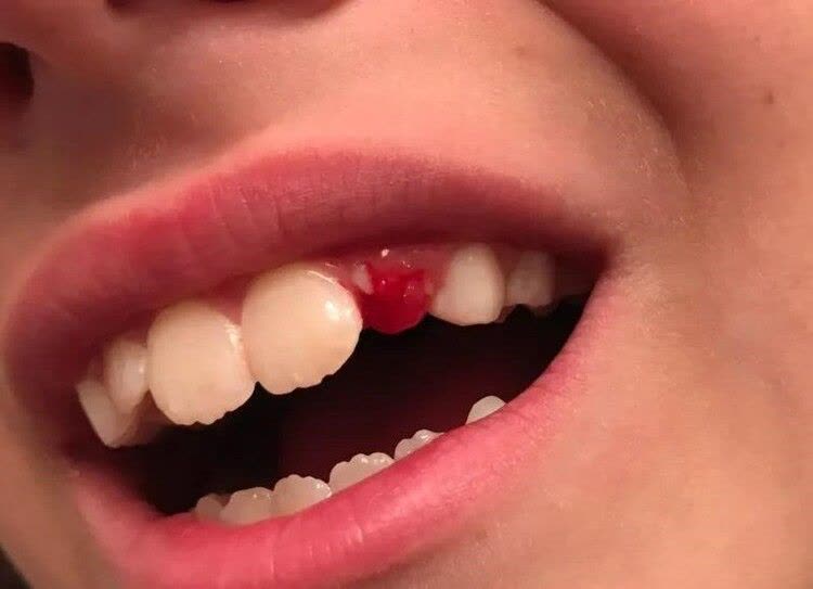 دندون بچه ام ضربه خورد و از جاش در اومد؛ چیکار کنم؟