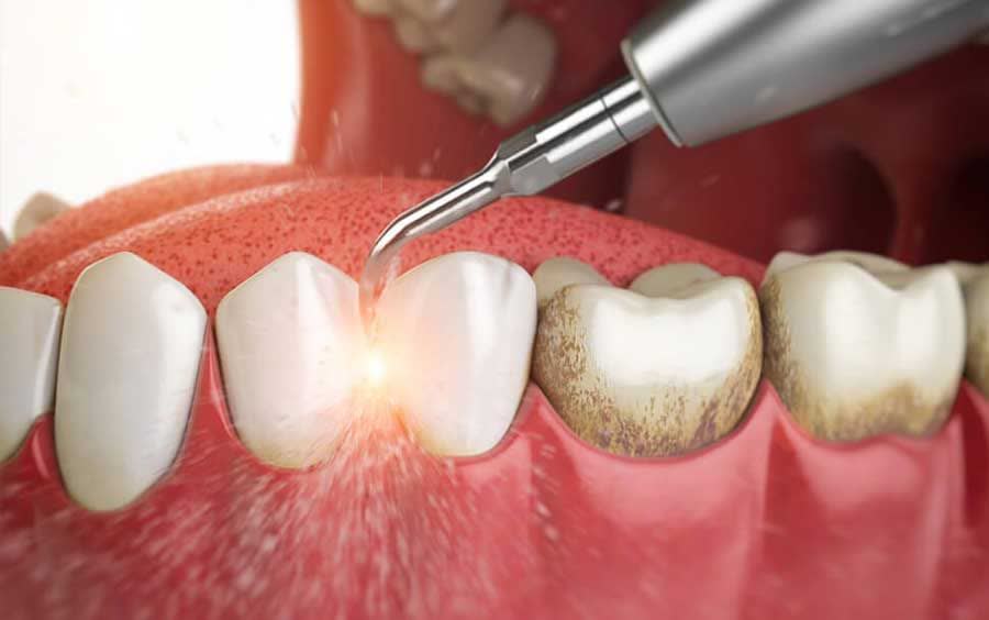 چرا باید برای جرمگیری زیر لثه‌ای اقدام کنیم؟