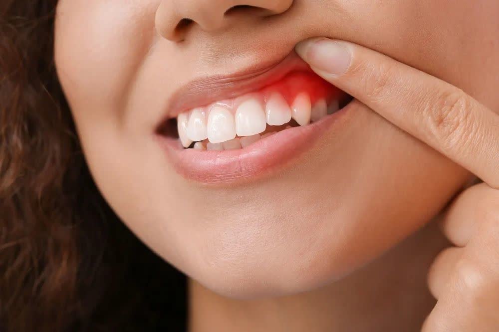 لثه‌های متورم و ملتهب نشانه چیست؟