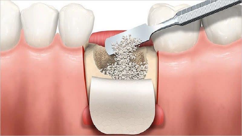 پیوند استخوان دقیقا چیست؟