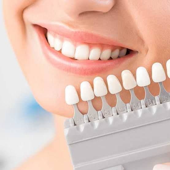 انواع روکش دندان چیست؟