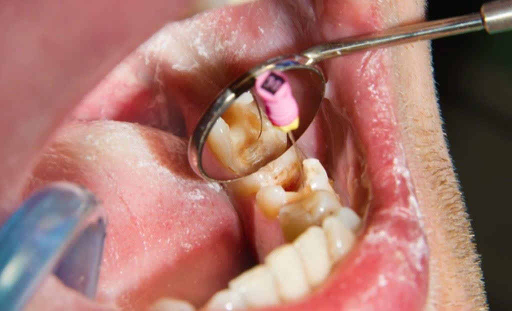 آیا لازم است جلسات متعدد درمان ریشه را تحمل کنم؟