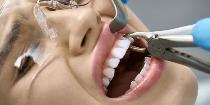چه زمانی باید دندانم را بکشم؟