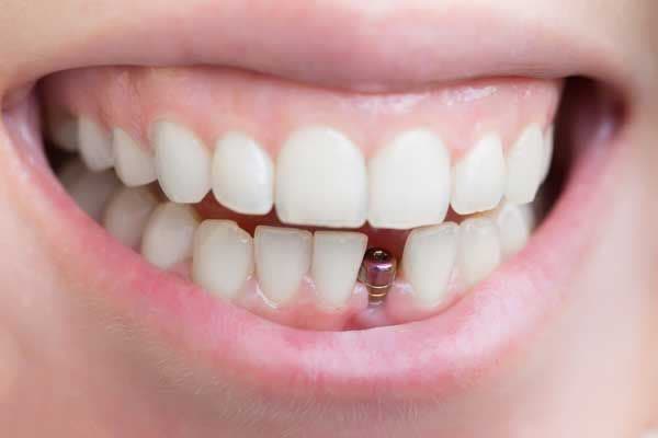 کدام سیستم ایمپلنت بهتر است؟